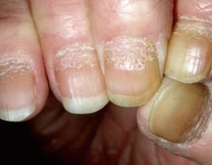 psoriasis des ongles