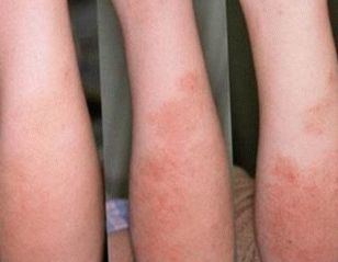 Comment se déroule la phase initiale du psoriasis chez les enfants?